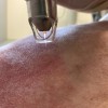 Cold Plasma trong chăm sóc vết thương: Cơ chế đột phá và ưu thế vượt trội trong lâm sàng