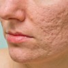 Plasma lạnh trị sẹo rỗ và se khít lỗ chân lông như thế nào?