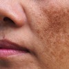 Cold Plasma: Bước tiến mới trong phục hồi và tái tạo làn da