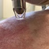 Giải pháp không kháng sinh giúp đẩy lùi bệnh da liễu mùa nóng ẩm 