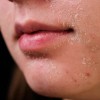 “Cứu” làn da nhiễm corticoid và tổn thương do peel, laser sai cách