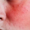 Plasma Lạnh và cơ chế kích hoạt khả năng phục hồi tự nhiên của da
