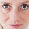 Hành trình trẻ hóa làn da, giảm nếp nhăn với công nghệ Plasma lạnh