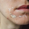 Bí quyết chăm sóc da sau can thiệp Laser và Peel: Giải pháp phục hồi từ công nghệ Cold Plasma