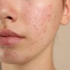 Kháng kháng sinh trong điều trị mụn và giải pháp thay thế từ tia Plasma lạnh