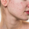 Plasma lạnh trị mụn - Giải pháp mới cho làn da khỏe đẹp