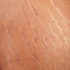 Ứng dụng Cold Plasma trong điều trị rạn da sau sinh và thay đổi cân nặng