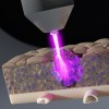 Plasma lạnh trong thẩm mỹ: An toàn hay tiềm ẩn rủi ro?
