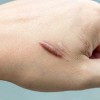 Nguy cơ biến chứng từ vết thương hở khó lành